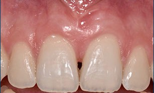 After Periodontitis Treatment