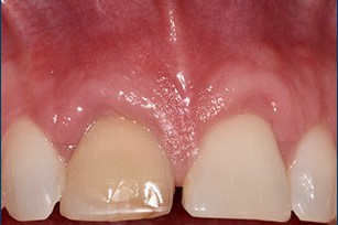 Recession on Central Incisors - After Treatment