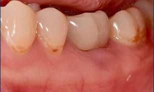 Missing Tooth – Replaced with Implant
